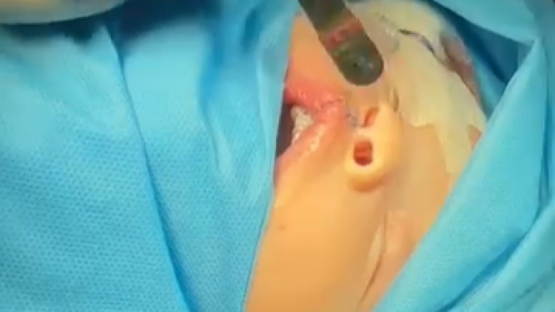 جراحی شکاف لب دکتر حمید رضا فتحی فوق تخصص جراحی پلاستیک