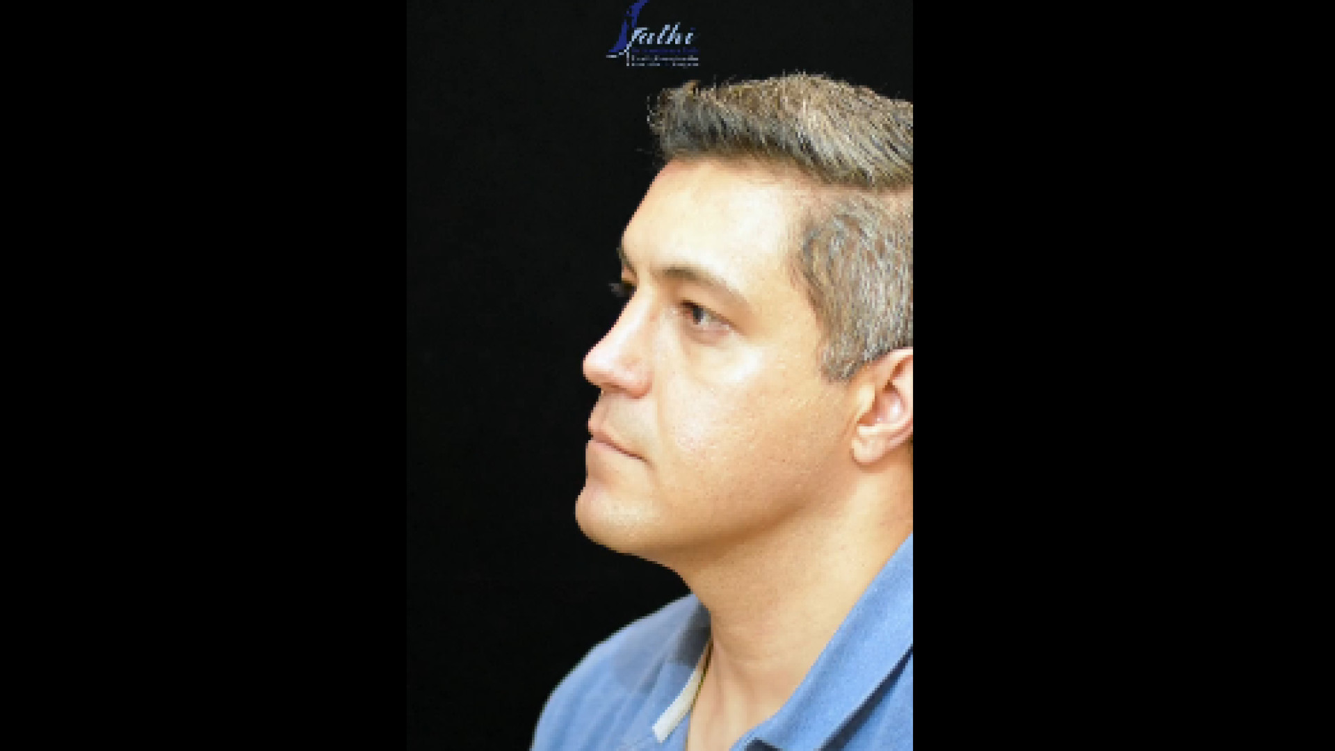 نمونه کار عمل بینی دکتر حمید رضا فتحی فوق تخصص جراحی پلاستیک