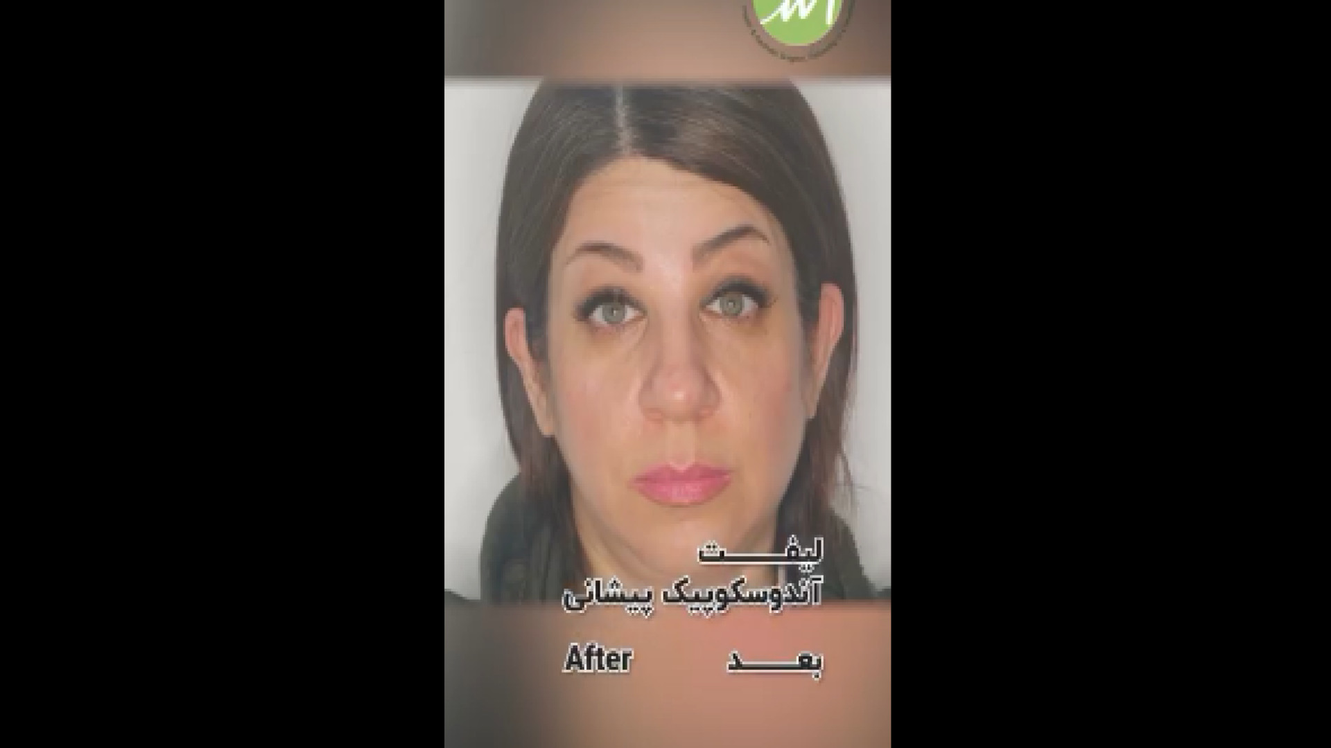 لیفت آندوسکوپی پیشانی گالکانی زوماب