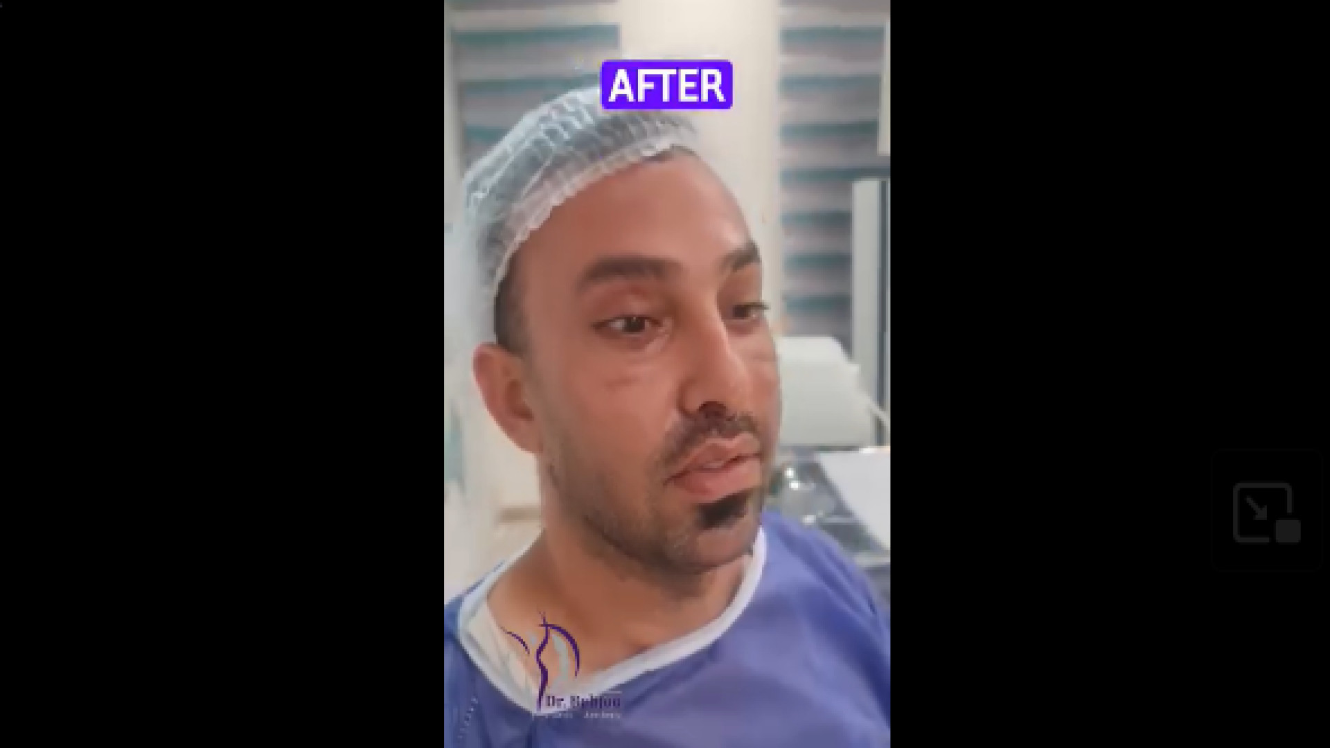 لیفت شقیقه پلک و سانترال لب دکتر شاهین بهجو - فوق تخصص جراحی پلاستیک