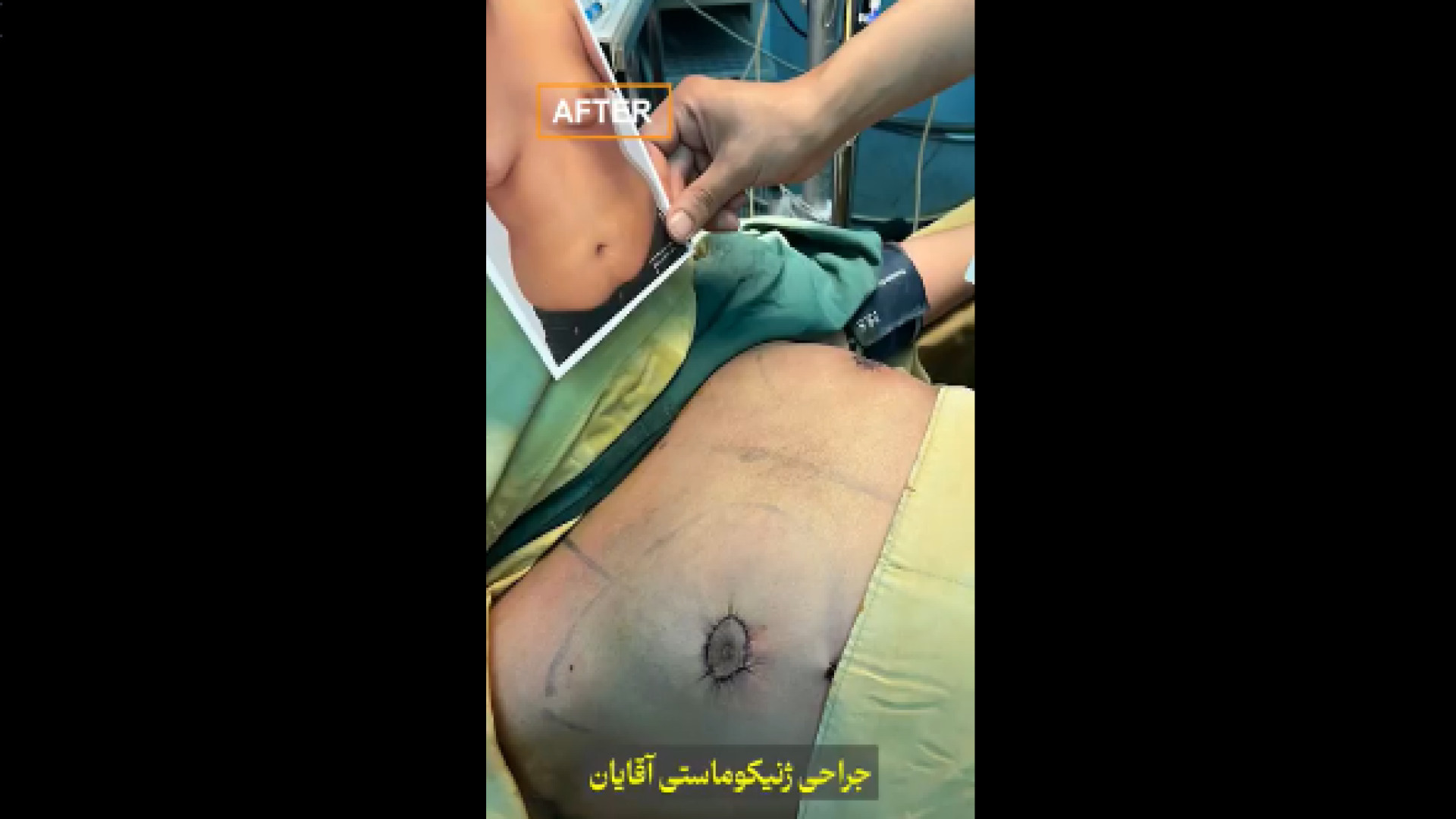 نمونه کار ژنیکوماستی دکتر شاهین بهجو - فوق تخصص جراحی پلاستیک