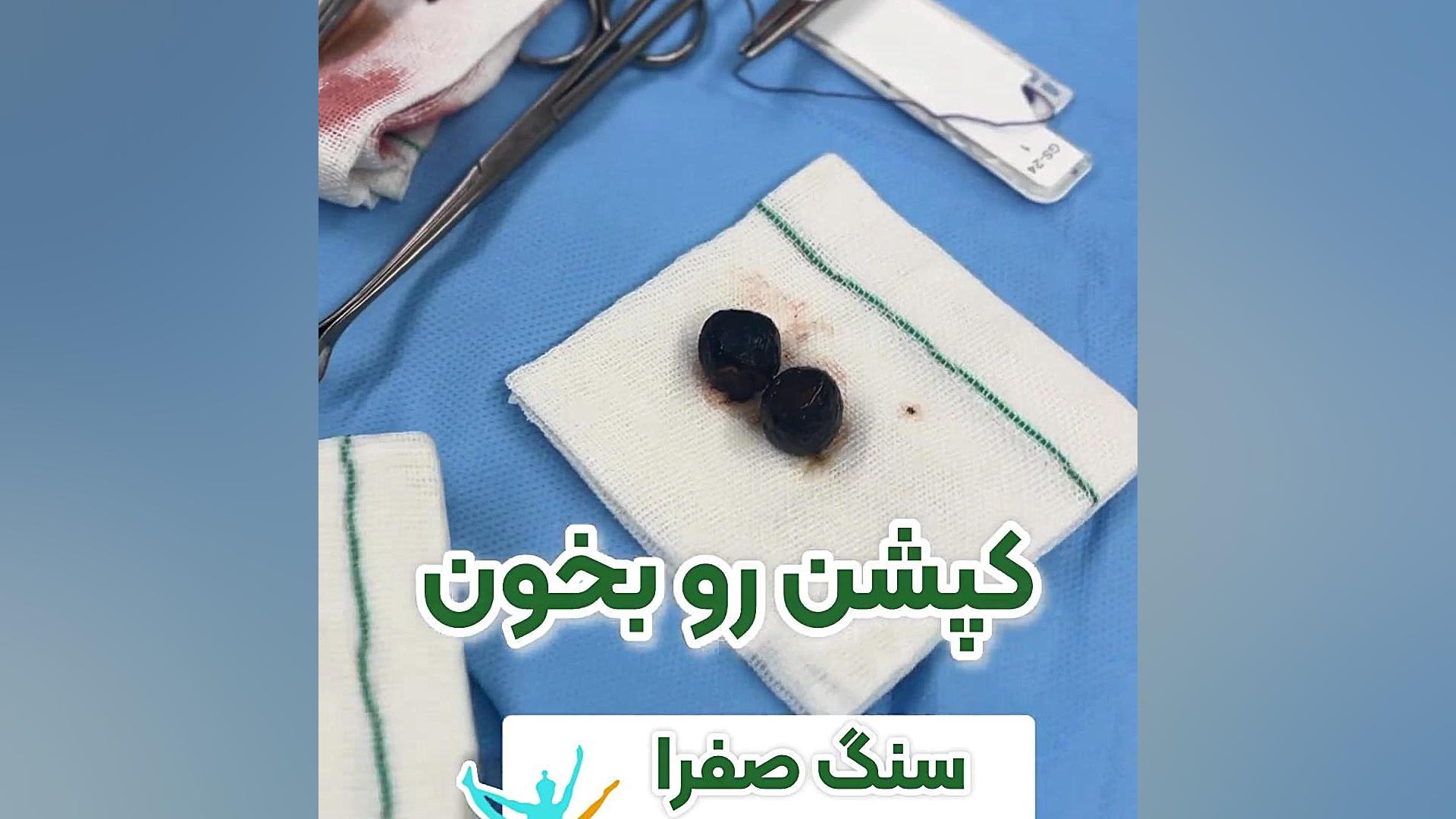 سنگ کیسه صفرا سحر دولتشاهی