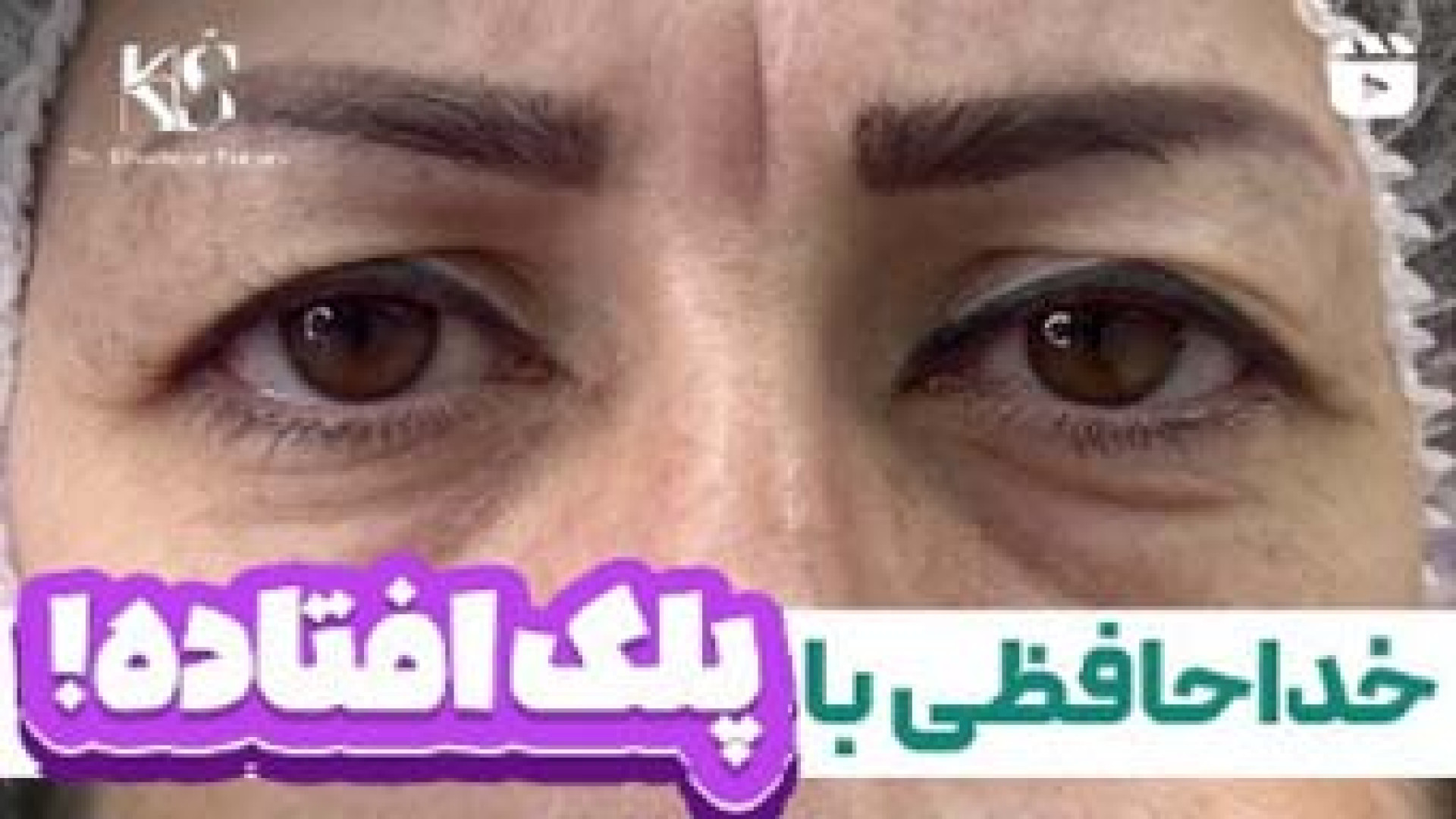 با بلفاروپلاستی جوان تر شوید | دکتر خشایار سنجری دکتر خشایار سنجری متخصص جراحی جنرال و زیبایی