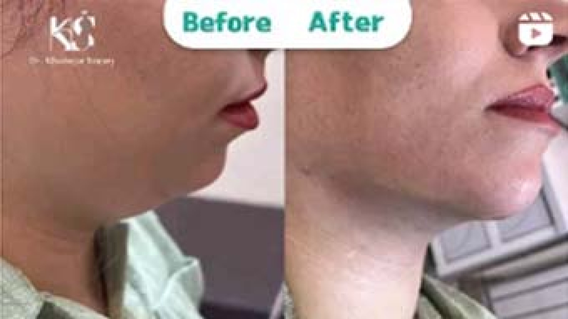 لیپوماتیک غبغب | دکتر خشایار سنجری دکتر خشایار سنجری متخصص جراحی جنرال و زیبایی