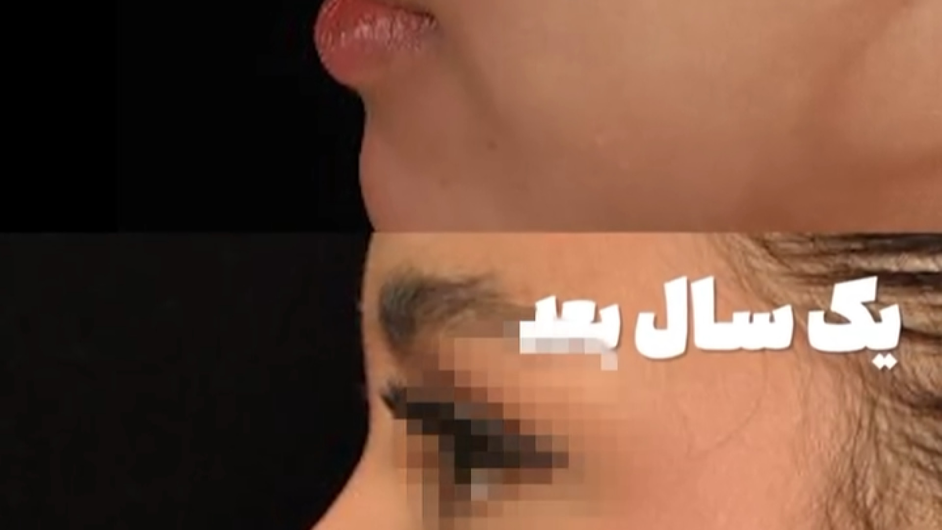 یکسال بعد از جراحی بینی دکتر فرهاد حافظی