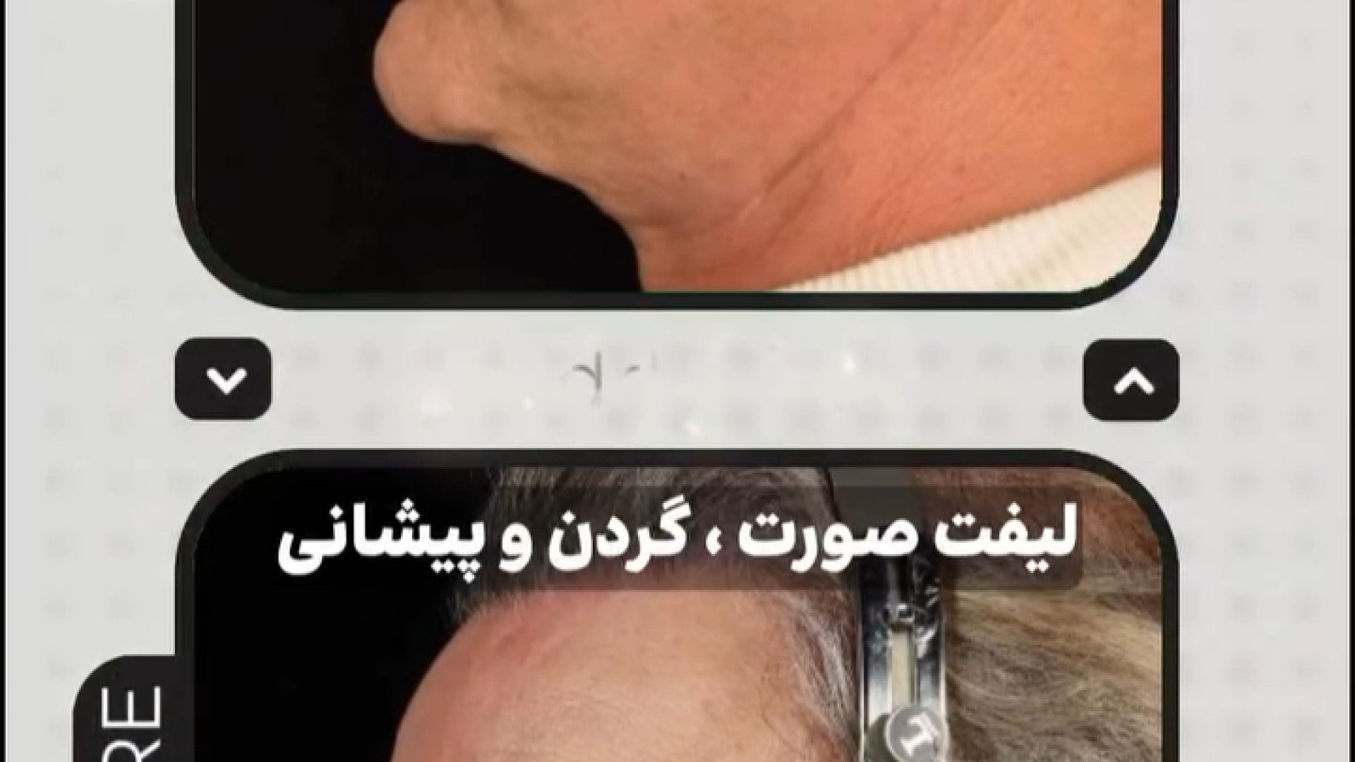 جراحی لیفت صورت، پیشانی و گردن لیفت پیشانی