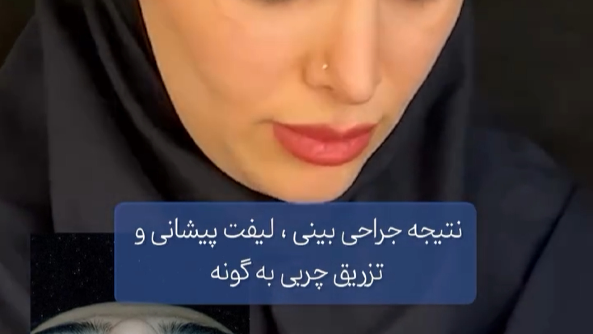 جراحی بینی همزمان با لیفت پیشانی و تزریق چربی به گونه دکتر فرهاد حافظی