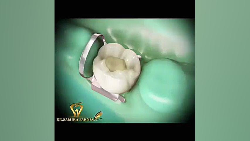 عصب کشی دندان مهدی مهدوی‌کیا
