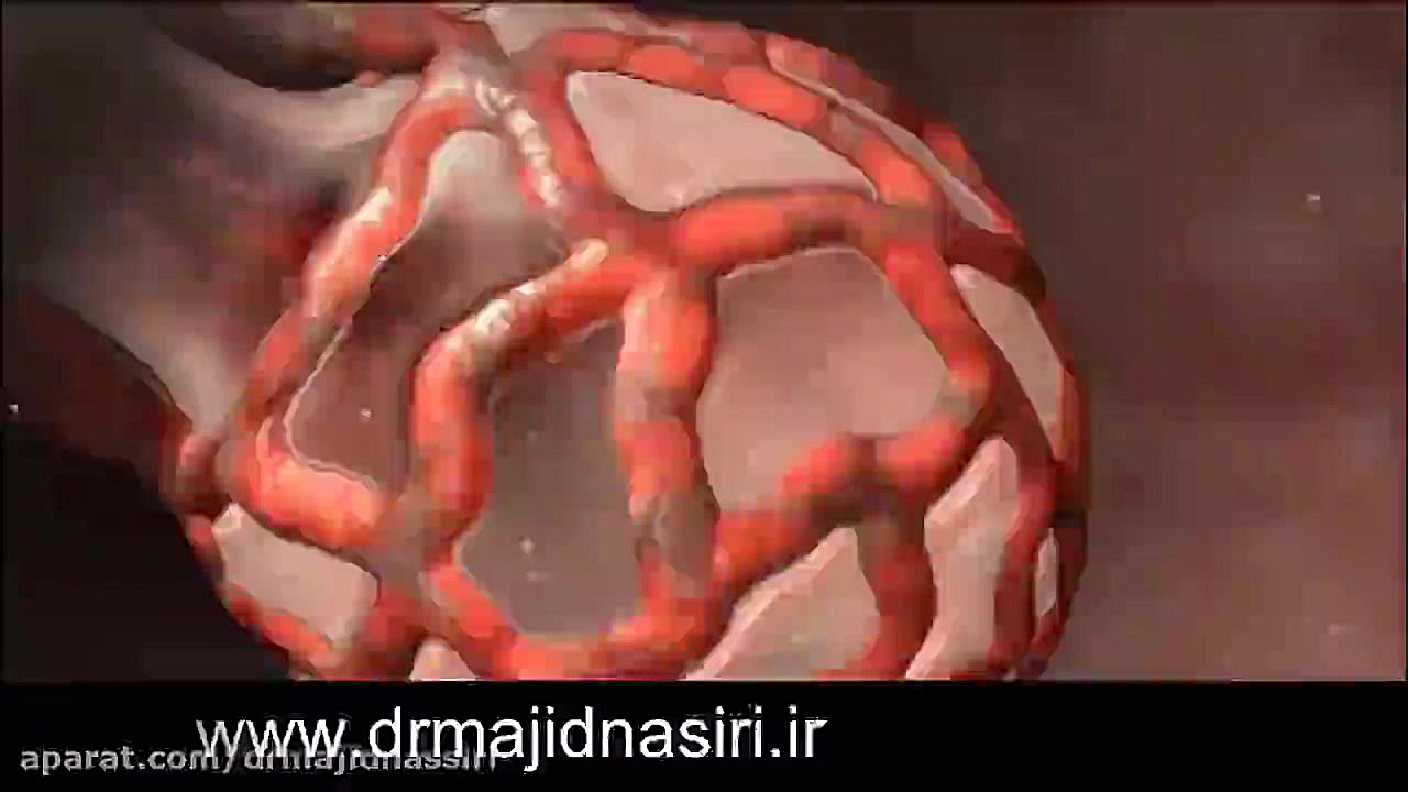 مکانیزم سرفه در بدن - درمان سرفه کودک جراحی پف زیر چشم
