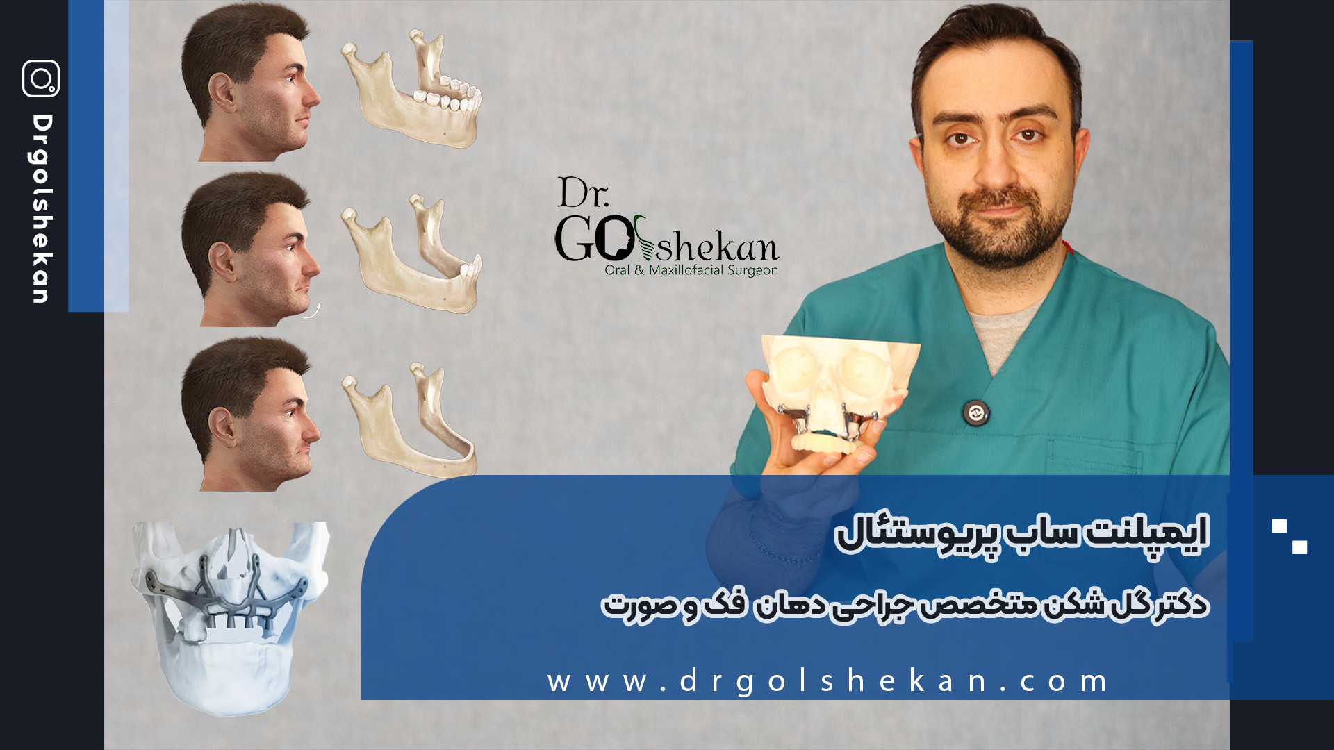 ایمپلنت ساب پریوستئال چیست؟ روشی برای کاشت ایمپلنت در رشت با دکتر هادی گلشکن کاتاپلکسی
