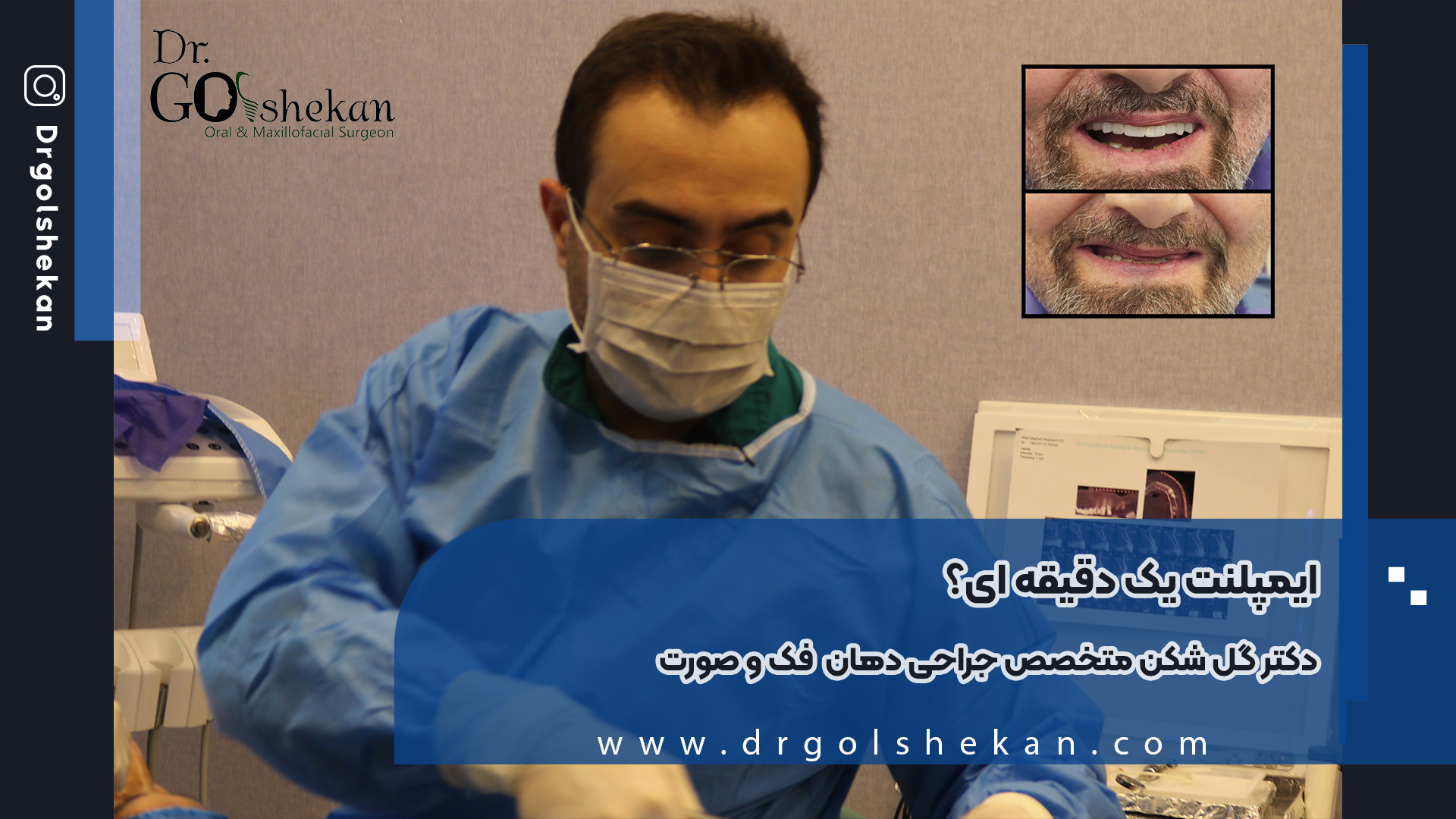 ایمپلنت فوری یا ایمپلنت یک دقیقه ای از زبان دکتر گلشکن بیورآکتور سه‌بعدی