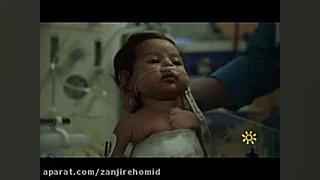 NICU زنجیره امید زاویه سازی صورت