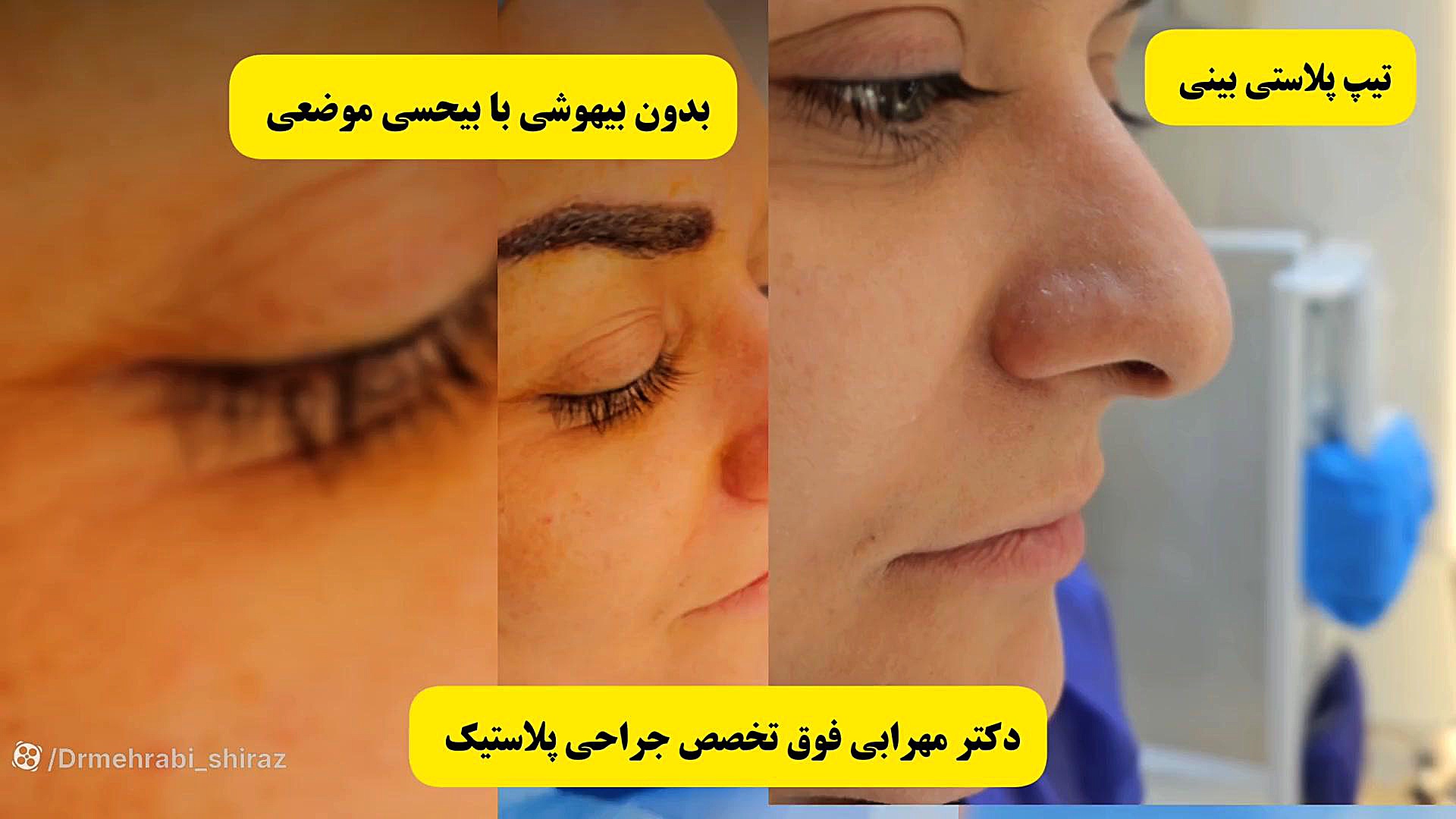 تیپ پلاستی بینی در شیراز بدون بیهوشی با بیحسی موضعی دکتر مهرابی دکتر محمد مهدی مهرابی جراح پلاستیک و زیبایی
