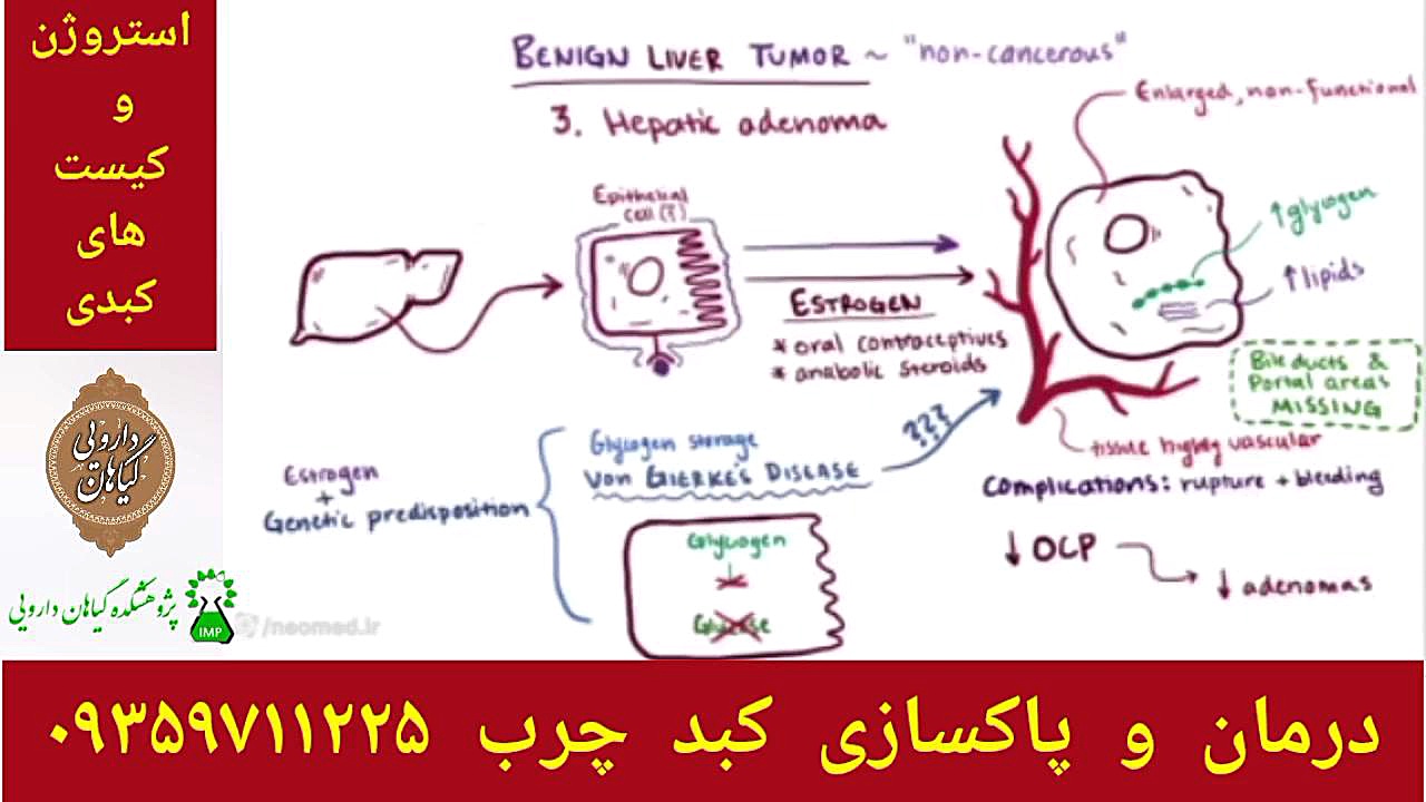استروژن و کیست کبدی درملن و پاکسازی کبدچرب ۰۹۳۵۹۷۱۱۲۲۵ عصب‌کشی
