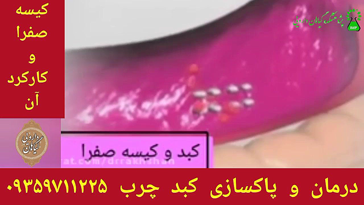 کارکرد کیسه صفرا درمان و پاکسازی کبدچرب ۰۹۳۵۰۷۱۱۲۲۵ ترمیم ونیر