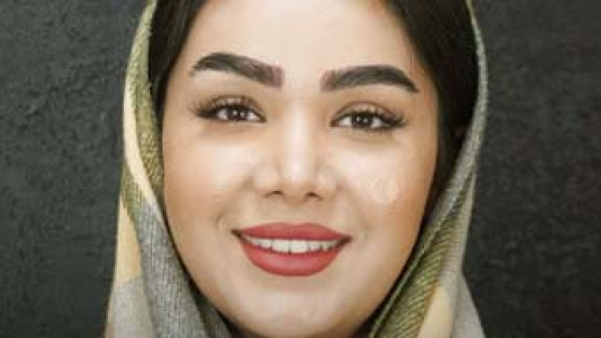 سه ماه بعد از جراحی همزمان بینی و ليفت اندوسکوپیک پیشانی و شقیقه ترمیم سوختگی