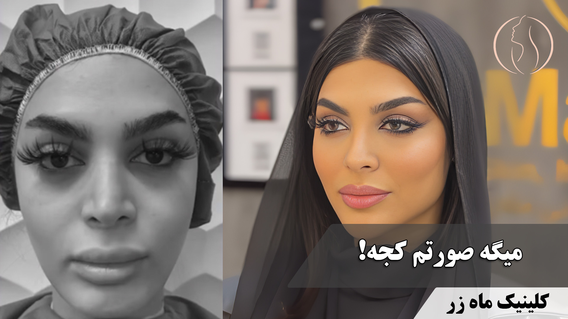 به همین راحتی همه چیز درست شد ( کلینیک زیبایی ماه زر ) آزمایش ایمونوسورپشن