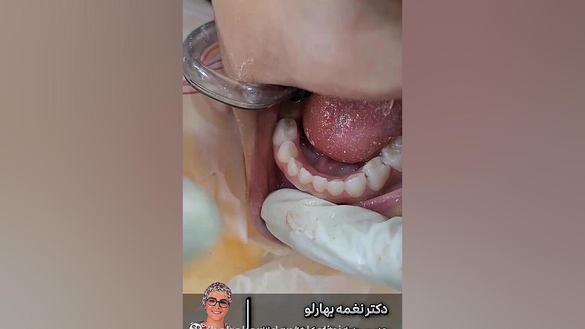 چرا باید نخ دندان بکشیم کلینیک دندانپزشکی بابکان