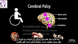 فلج مغزی، دلایل و راه های درمان آن