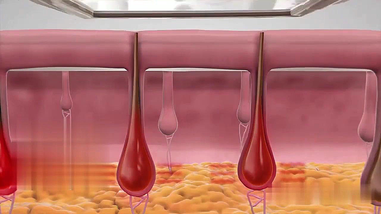 نحوه عملکرد لیزر دایود|تاثیر لیزر بر مو|بخش دوم میکرونیدلینگ