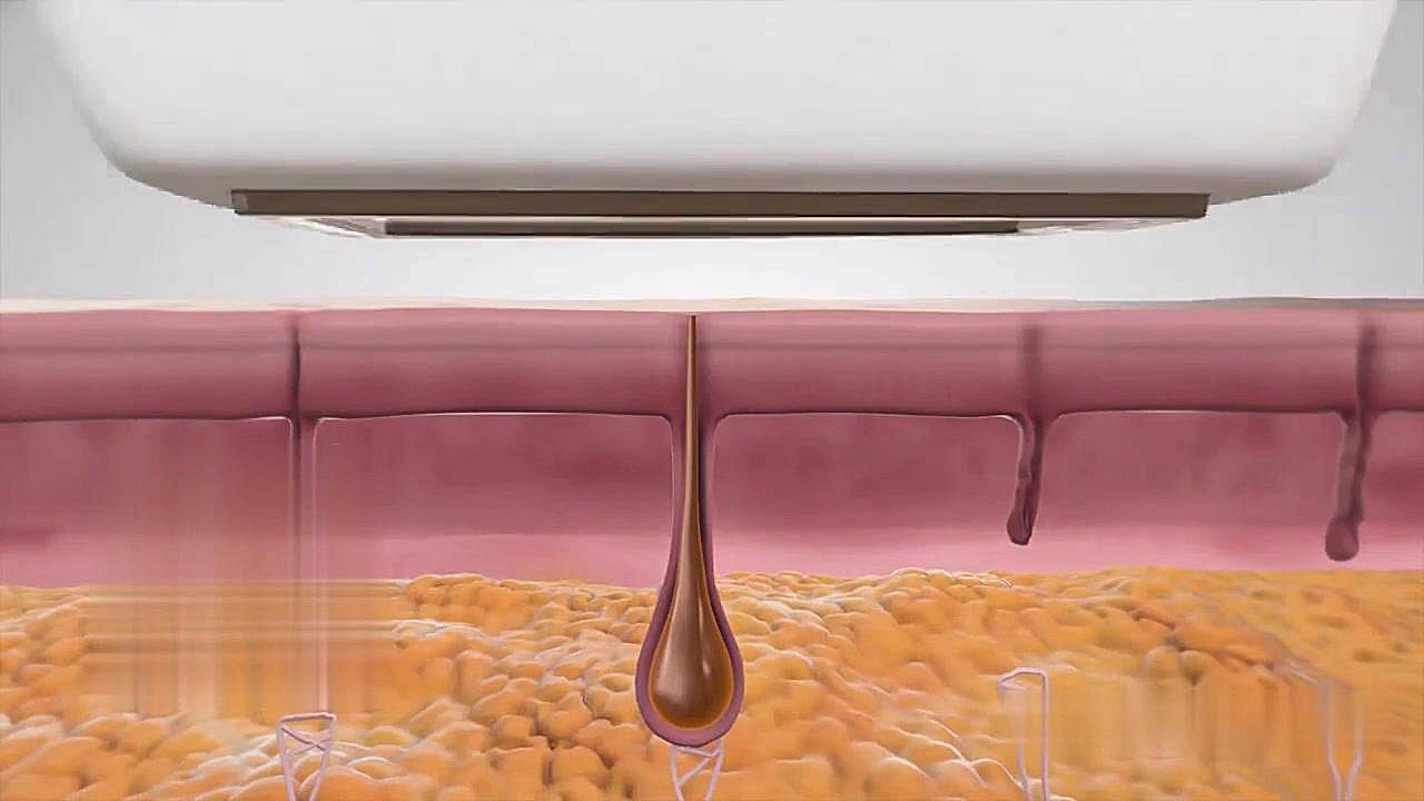 نحوه عملکرد لیزر دایود|رشد مو در برخی از نواحی|بخش سوم Anti-CCP