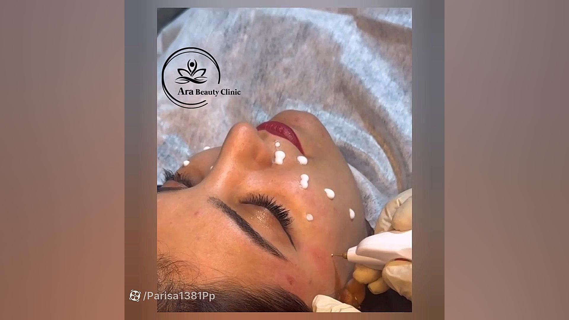 کلینیک پوست،مو و لیزر آرا اکتروپیون