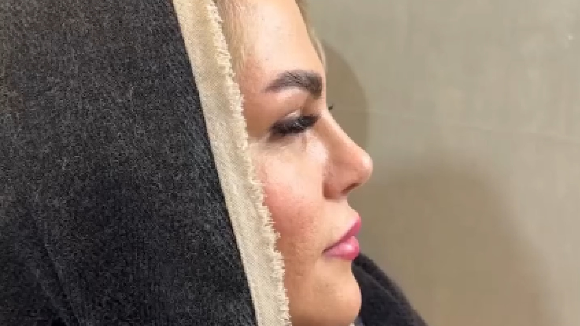 نتیجه جراحی بینی بعد از سه ماه | دکتر علی باقری حق دکتر علی باقری حق