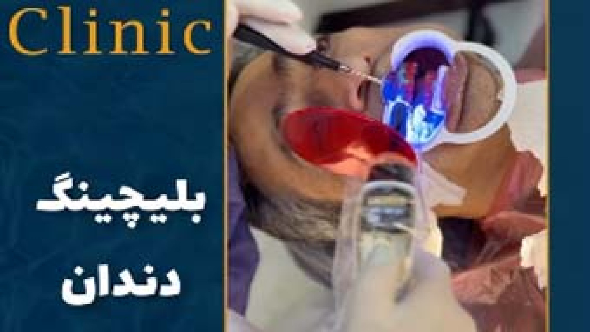 بلیچینگ دندان | کلینیک باشار پزشکی کانابینوئید
