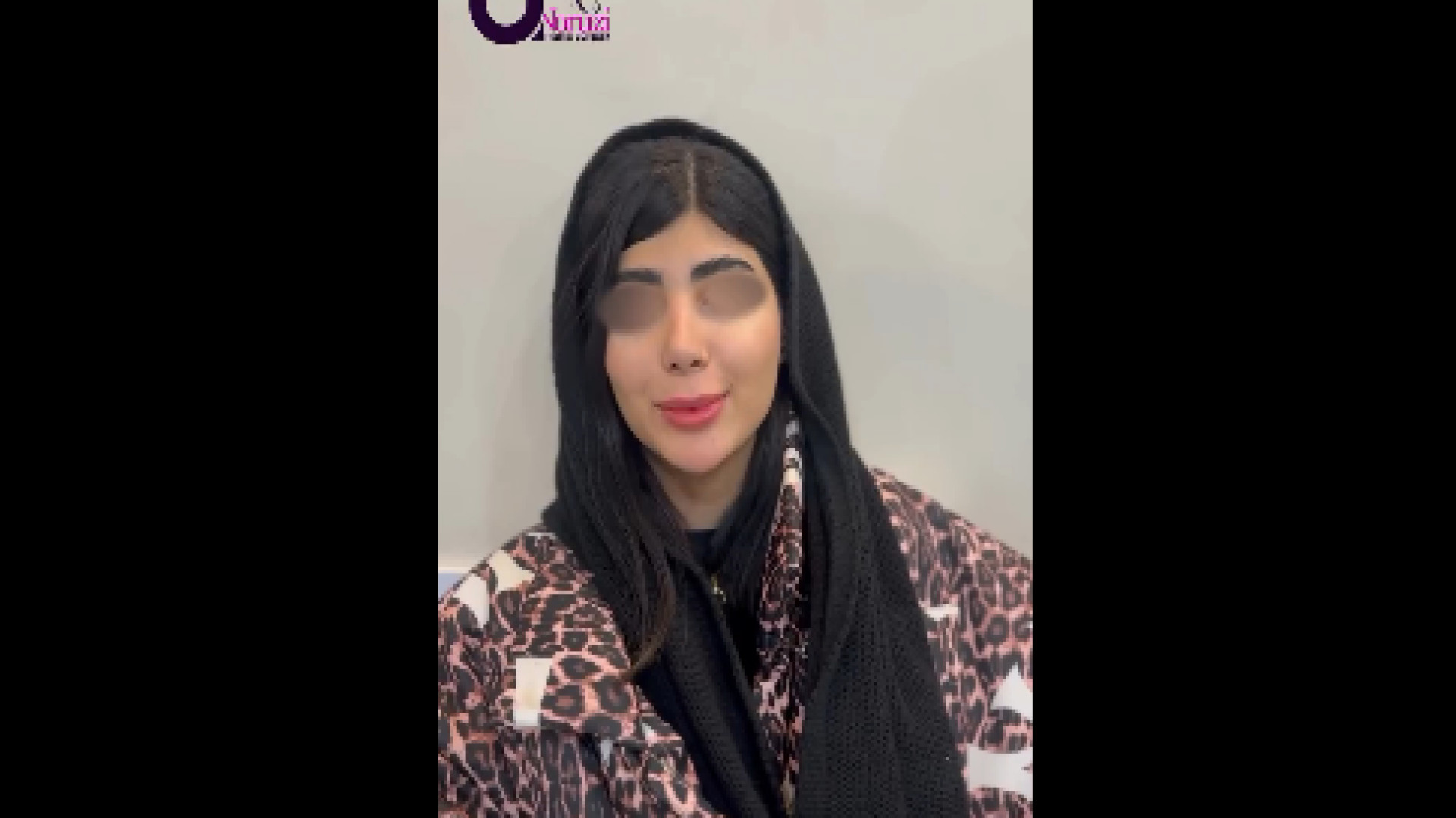 رضایت از عمل بینی لیفت صورت