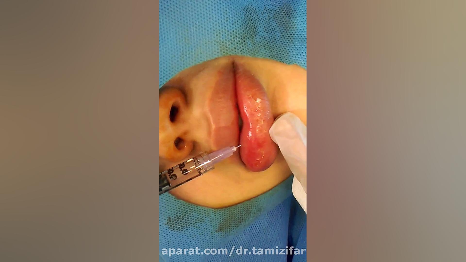 اصلاح تزریق غیر اصولی ژل در لب دکتر بنفشه تمیزی فر