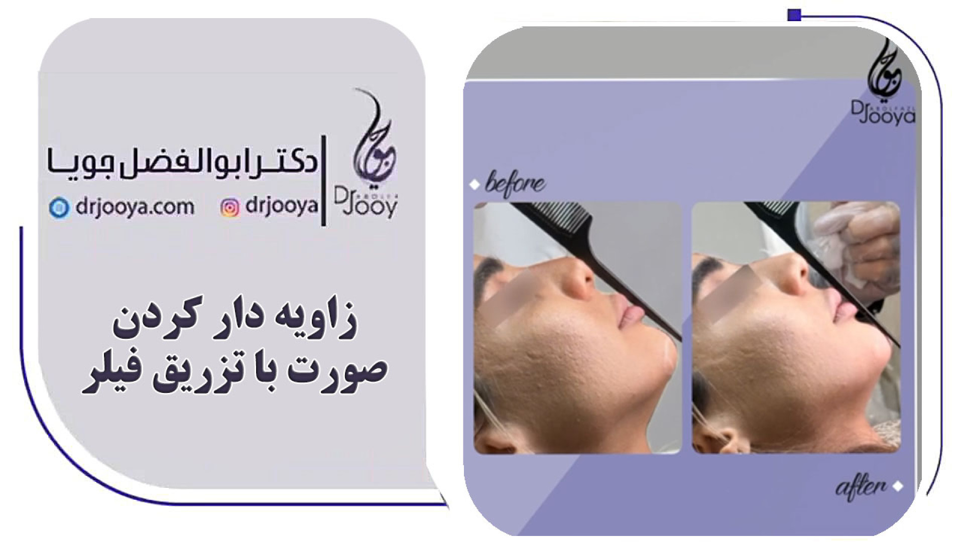 زاویه دار کردن صورت با تزریق فیلر دکتر ابوالفضل جویا