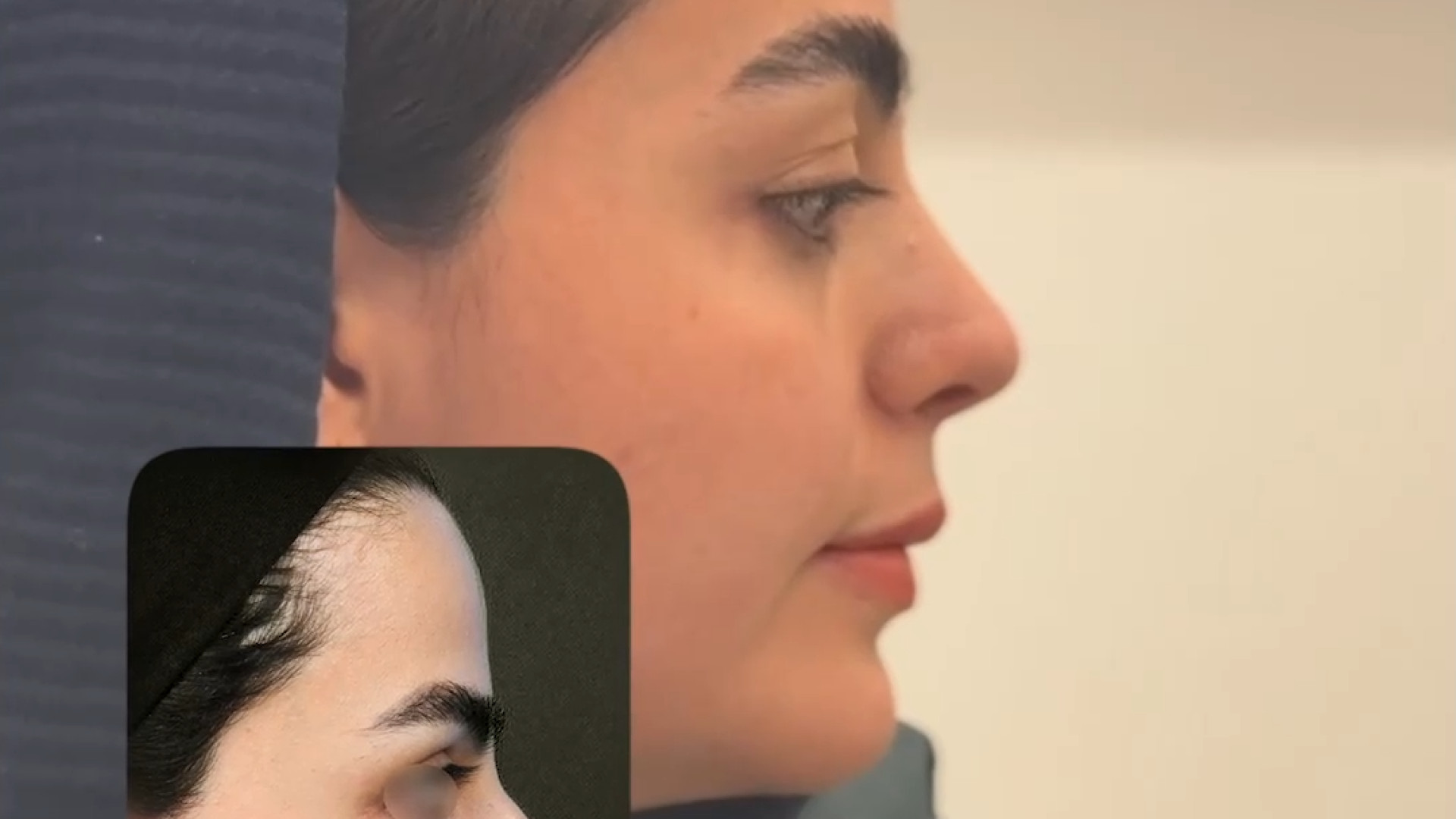 جراحی انحراف بینی با دکتر علیرضا محبی