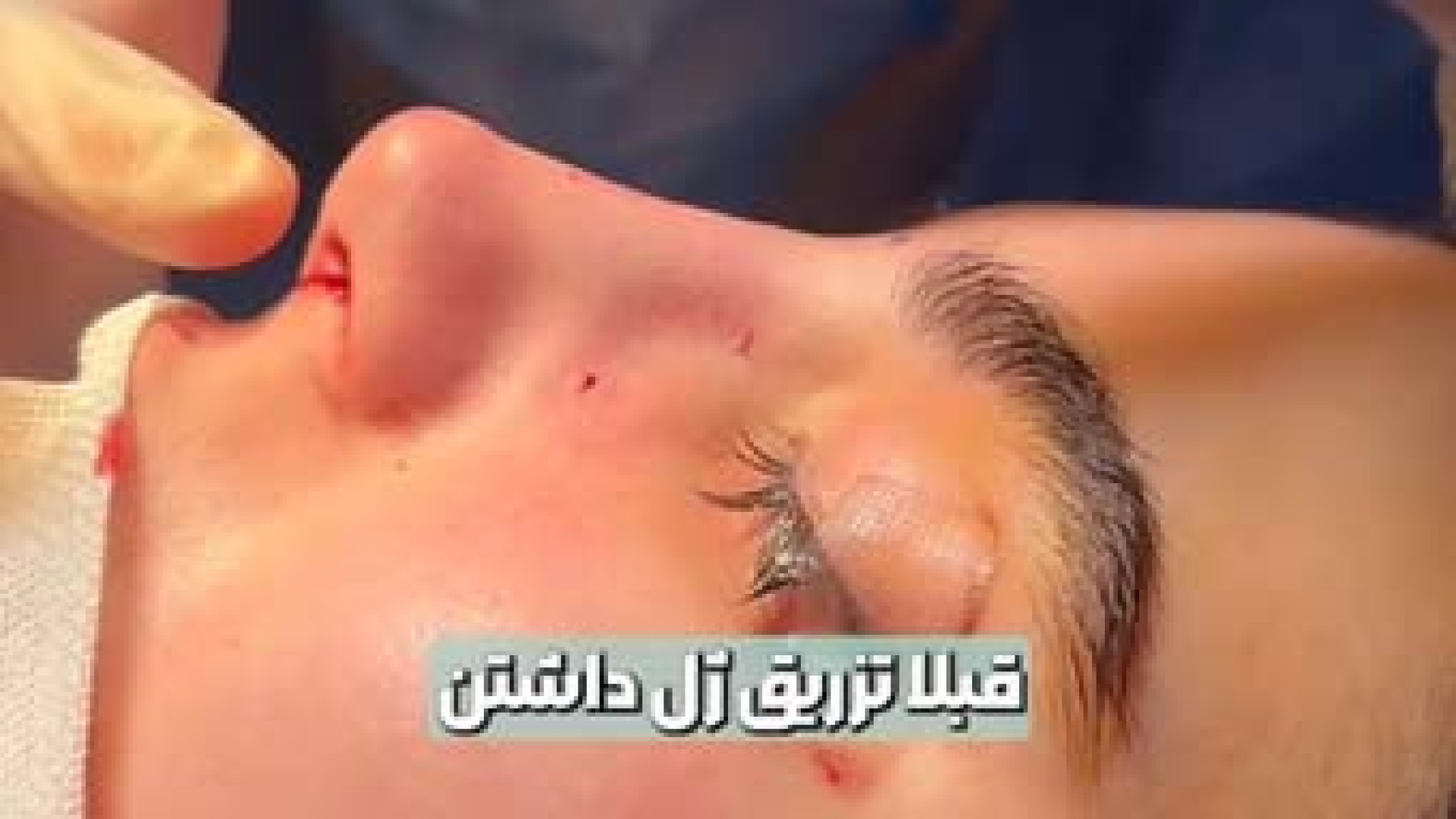 تزریق فیلر و آنزیم به بینی را به هیچ عنوان توصیه نمیکنیم! عصب‌کشی