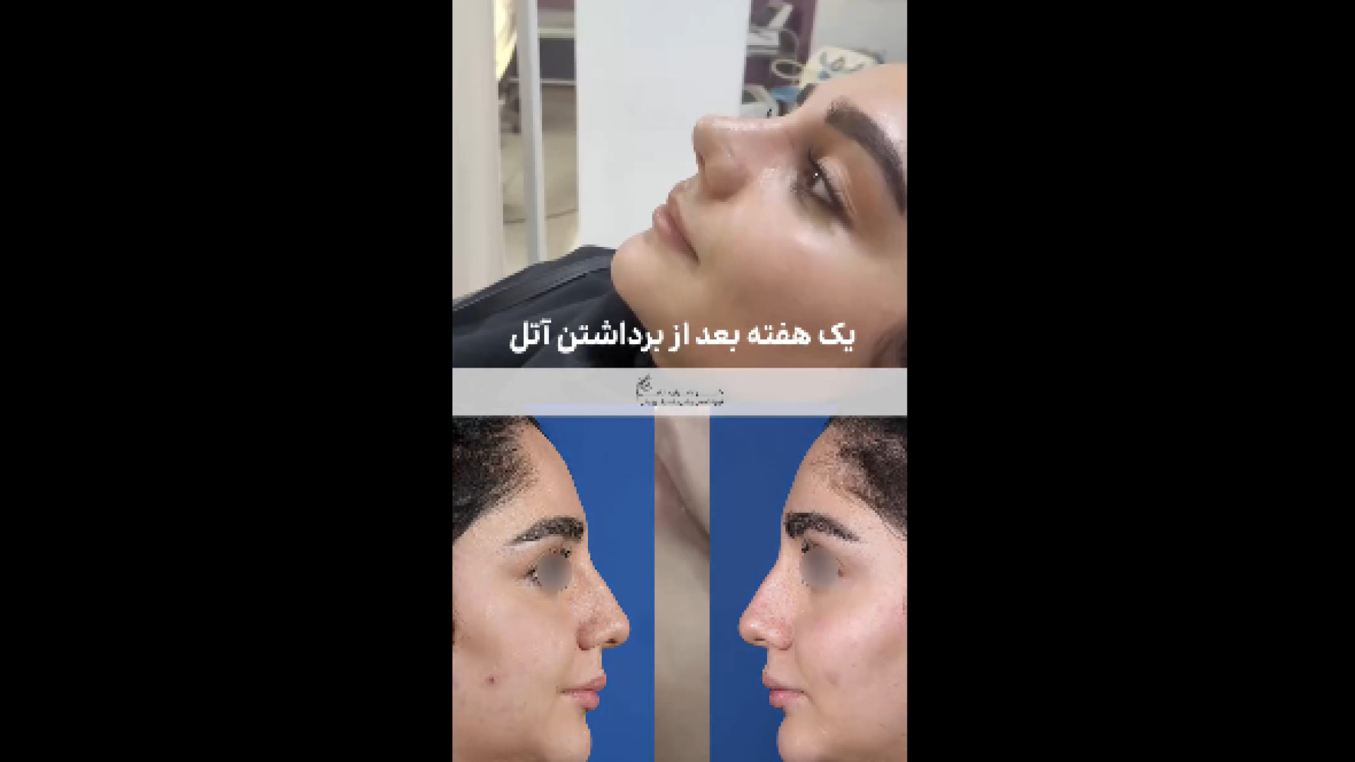 یک هفته بعد از عمل بینی دکتر کامران بابایی