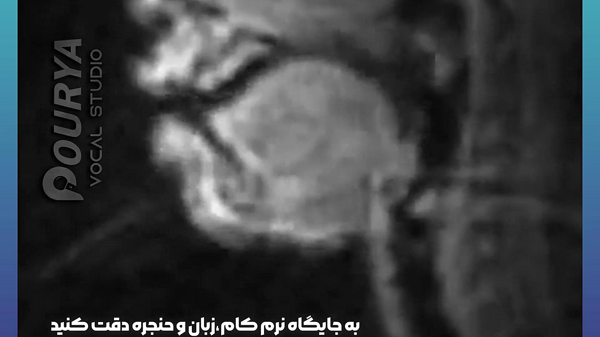 آنالیز صدای خوانندگان با MRI لیزر مو