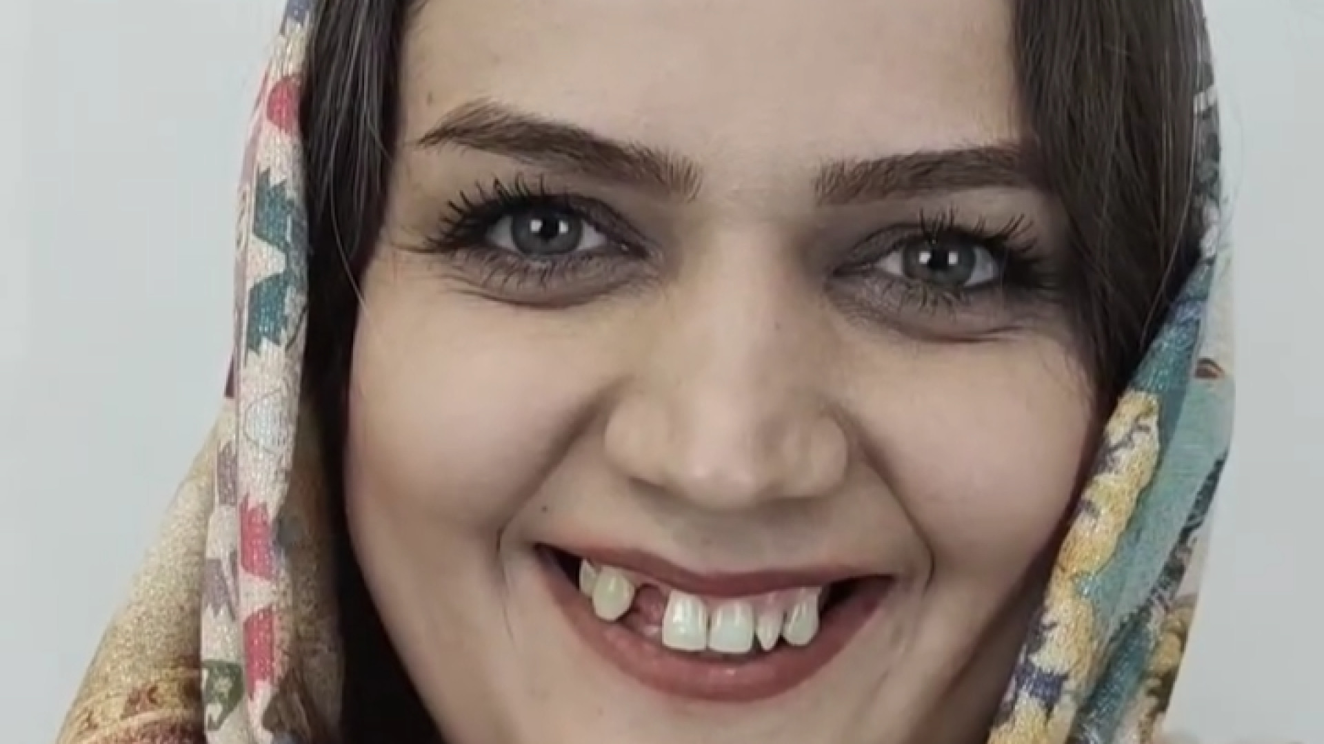 فیلم قبل از درمان دو فک با روکش و لمینت سرامیکی، ایمپلنت و جراحی لثه قارچ‌شناسی پزشکی