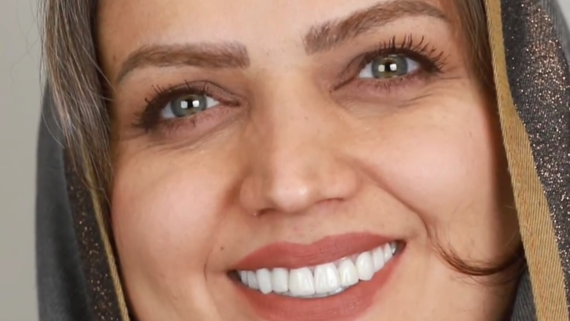 فیلم بعد از درمان دو فک با روکش و لمینت سرامیکی، ایمپلنت و جراحی لثه کلونینگ درمانی