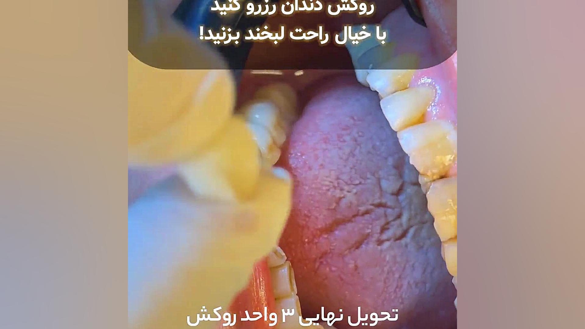 روکش دندان بیماری مایکلیناپاتی