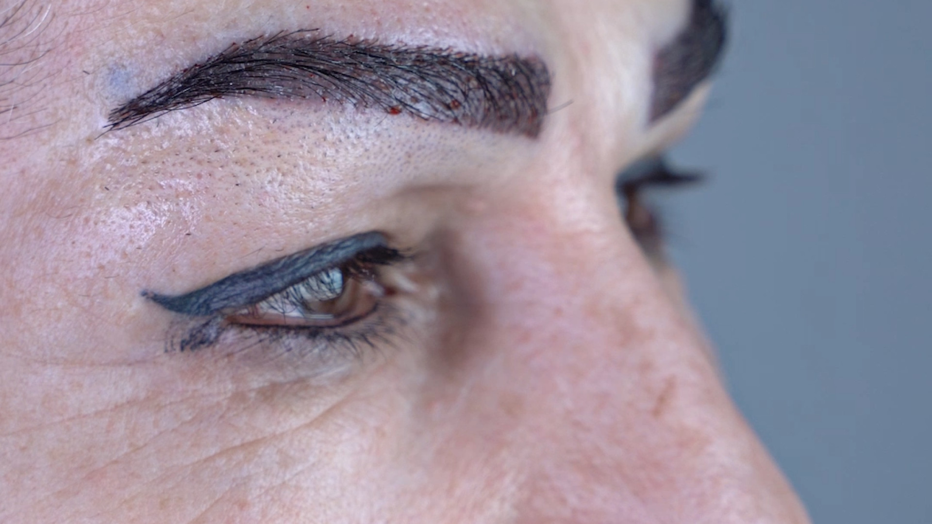 کاشت ابرو با ۸۰ درصد موی سفید در کلینیک ساعی! پیلینگ شیمیایی