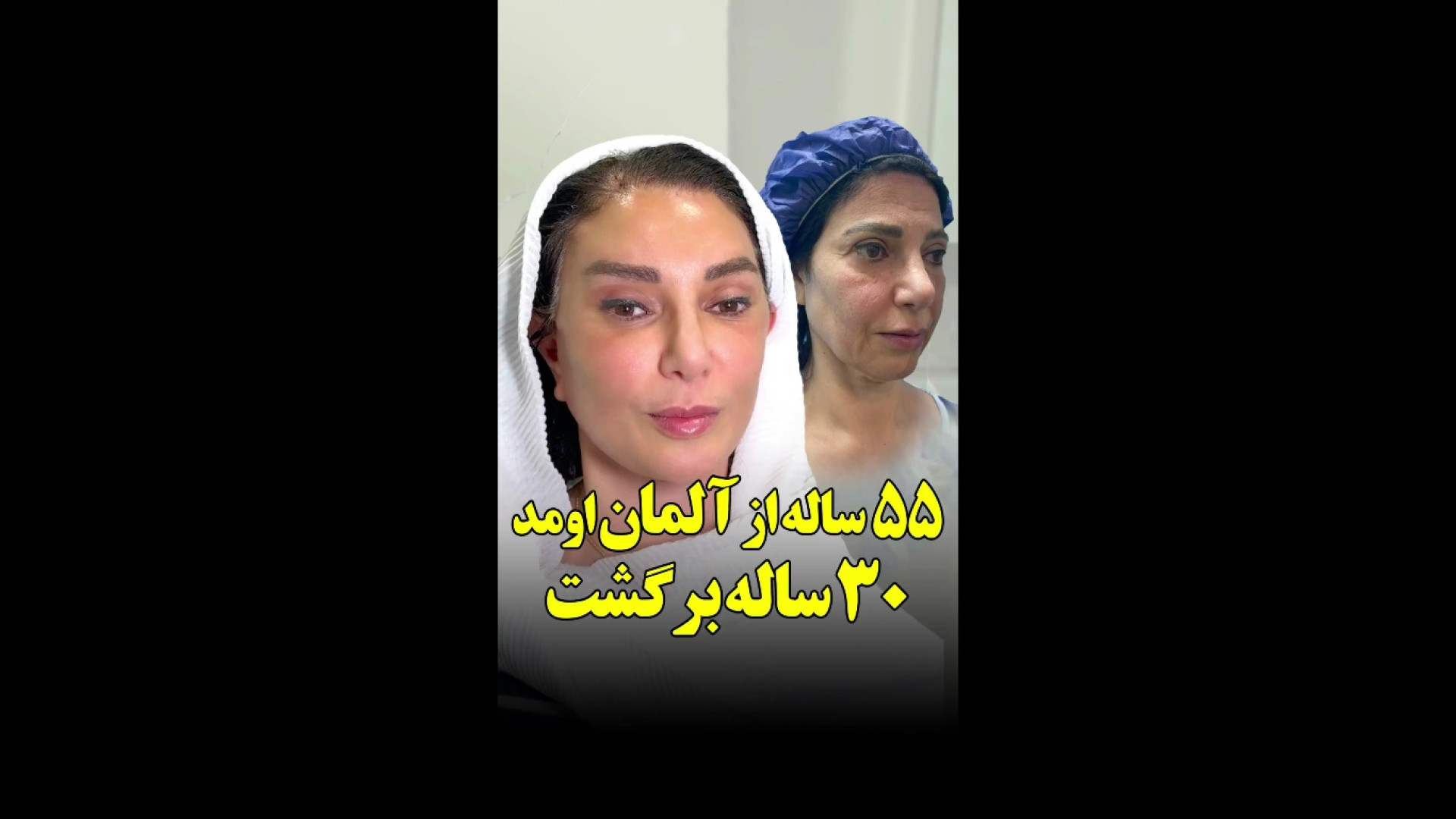 55 ساله از آلمان اومد، 30 ساله برگشت | لیفت صورت و گردن پر کردن دندان
