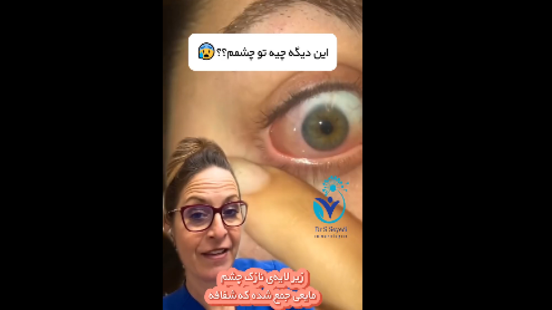 آلرژی چشمی تزریق چربی