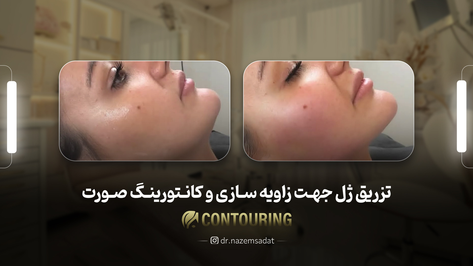 تزریق ژل جهت زا ویه سازی و کانتورینگ صورت | دکتر منیرالدین ناظم السادات دکتر سید منیرالدین ناظم السادات