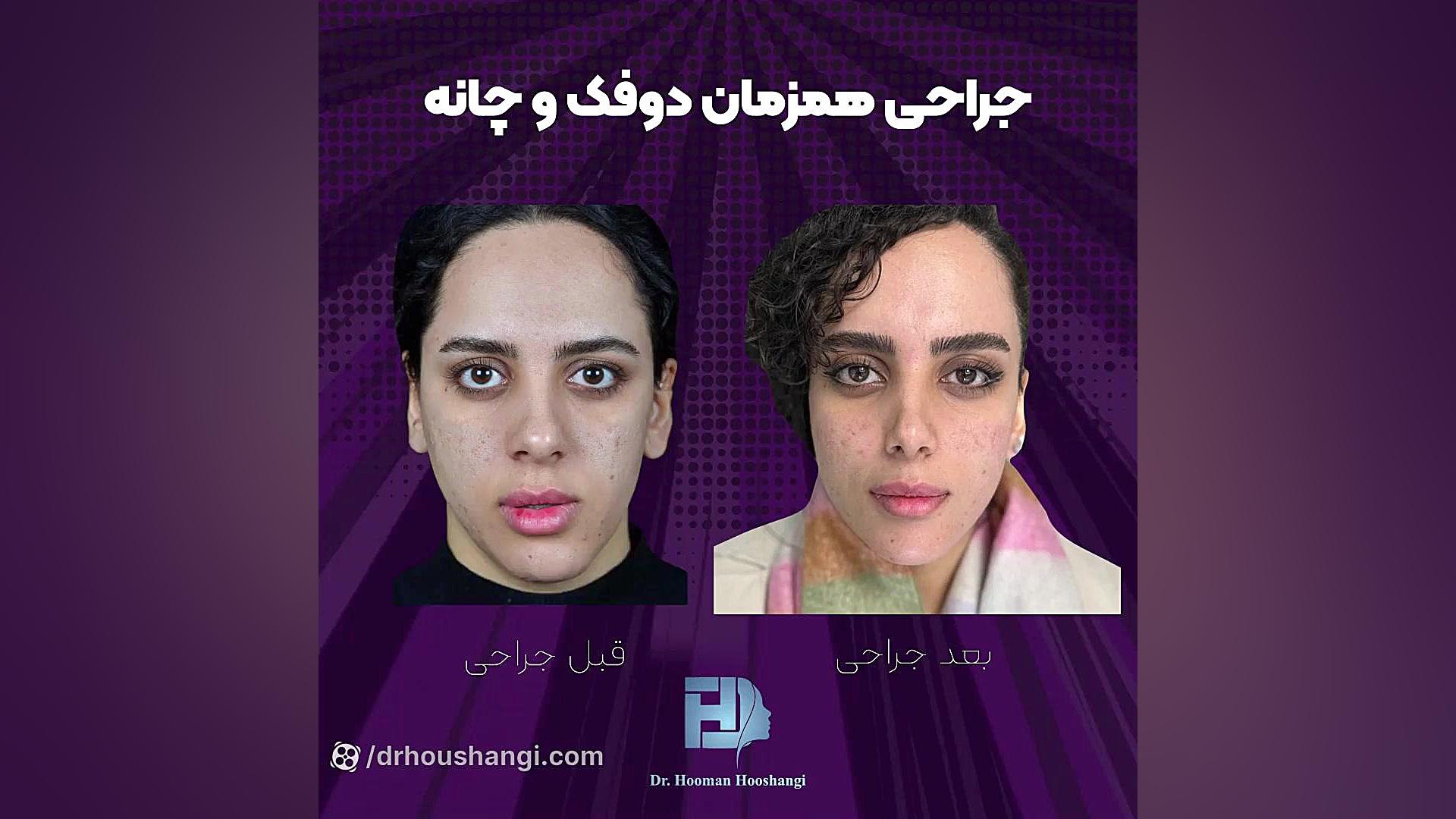 قبل و بعد جراحی چانه کلینیک زیبایی