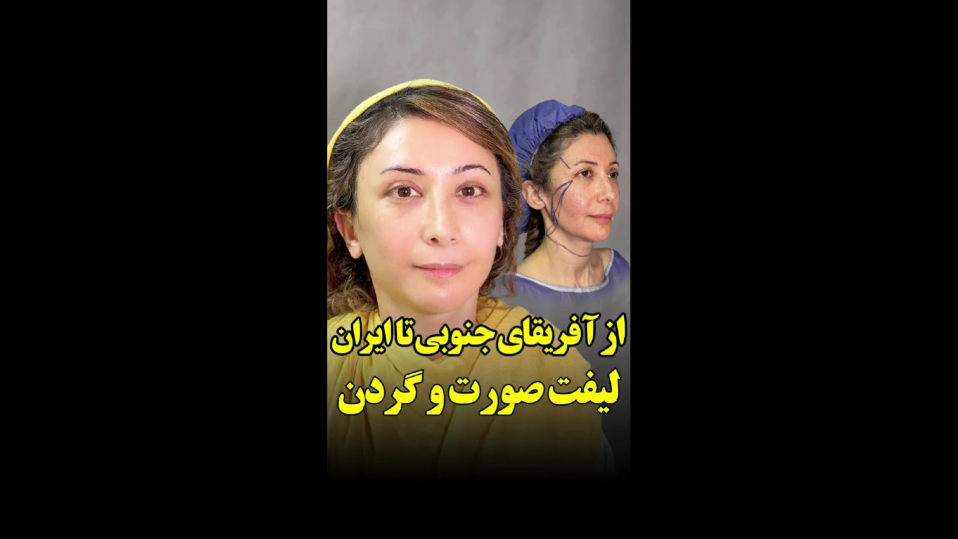 از آفریقای جنوبی تا ایران | سوپر لیفت صورت و گردن هوش مصنوعی ترند