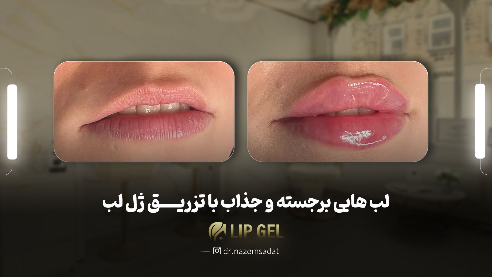 لب هایی برجسته و جذاب با تزریق ژل لب | دکتر منیرالدین ناظم السادات دکتر سید منیرالدین ناظم السادات