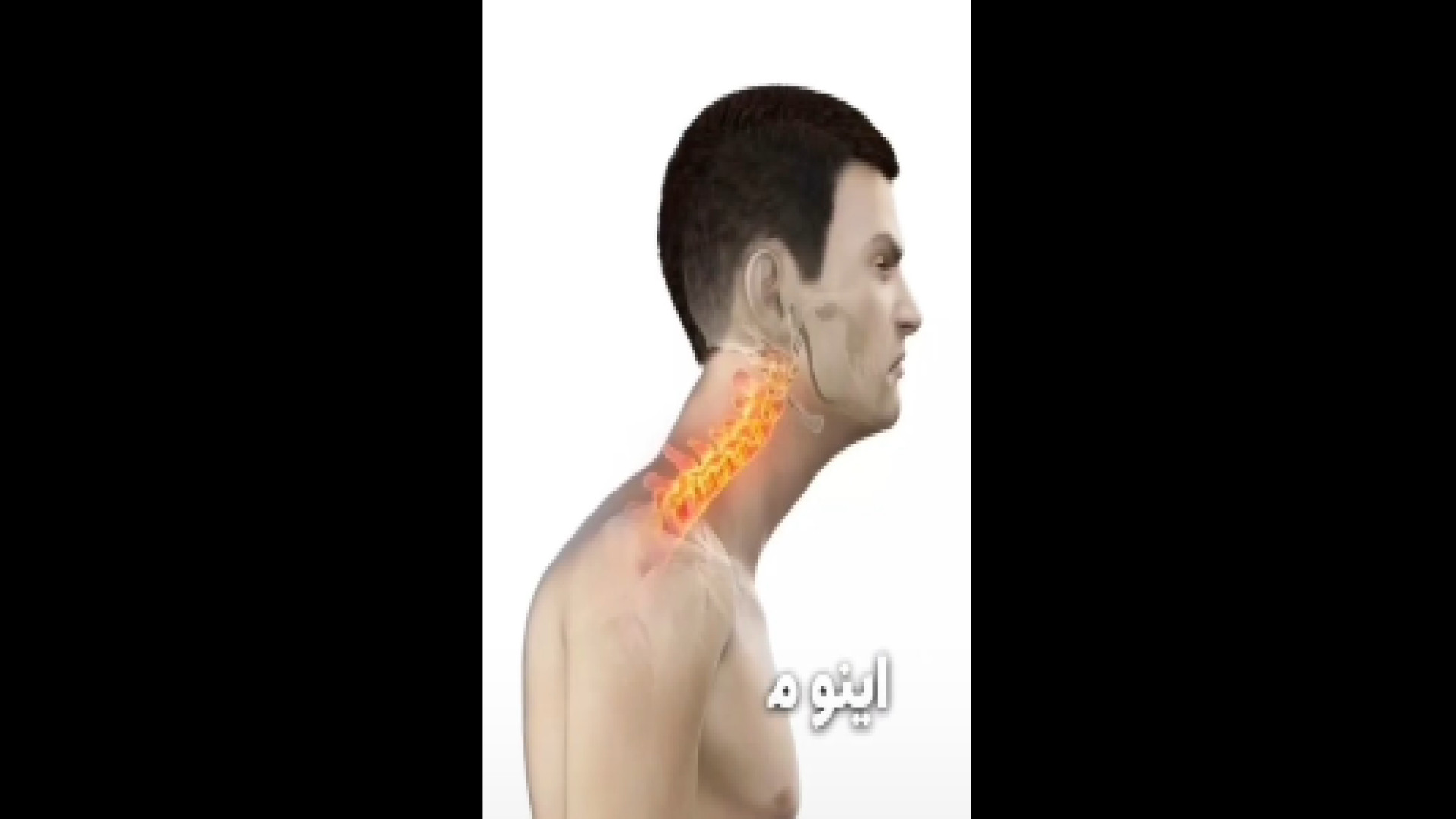 عوامل ایجاد قوز کمر دکتر آرش اریس