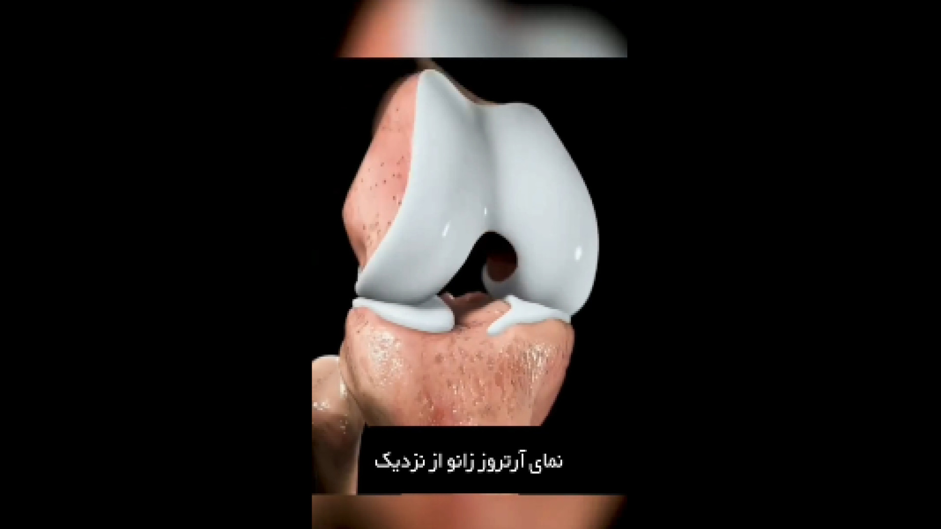 ویدیو آرتروز زانو دکتر آرش اریس