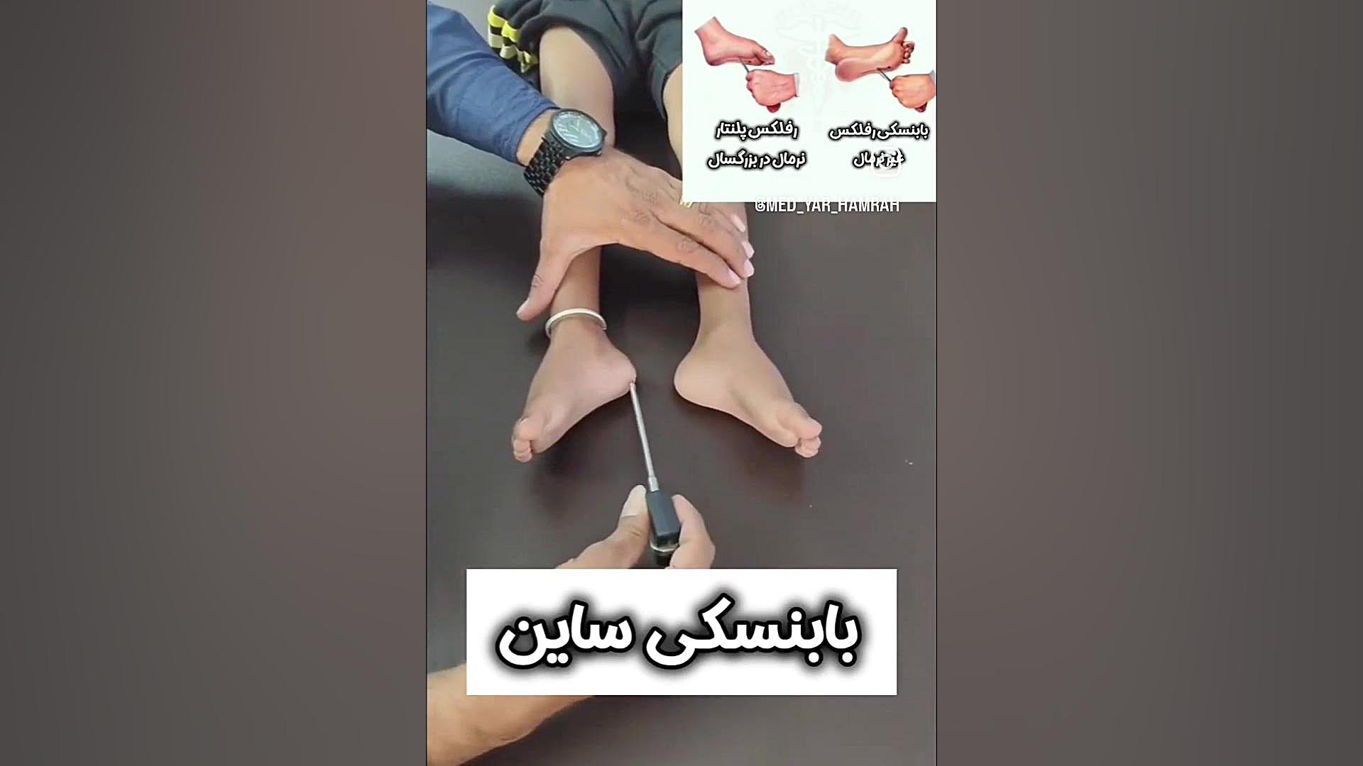 بابنسکی مثبت بلیچینگ
