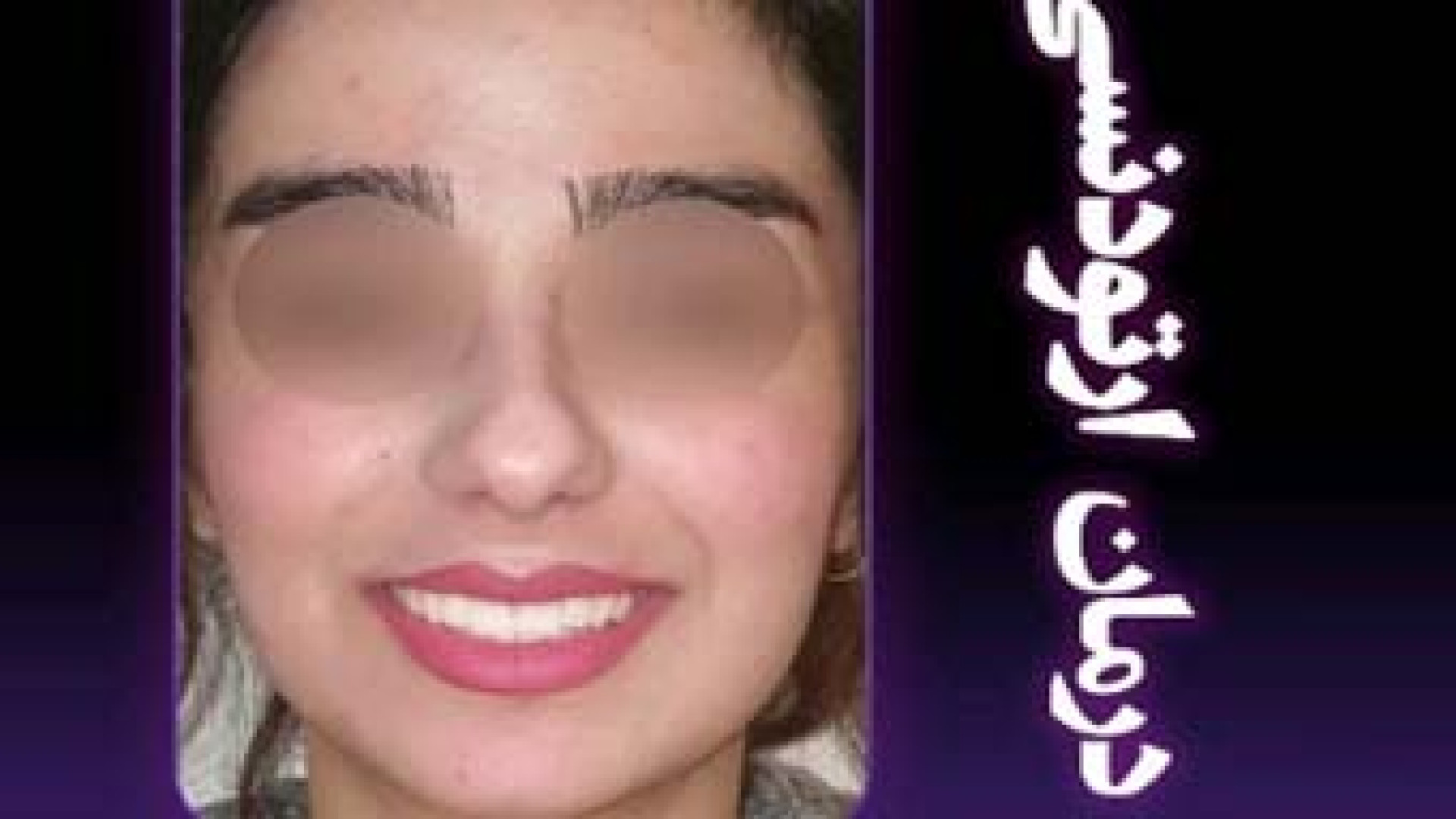 درمان ارتودنسی ثابت دو فک | دکتر ثریا یوسف نژاد دکتر ثریا یوسف نژاد متخصص ارتودنسی بابل