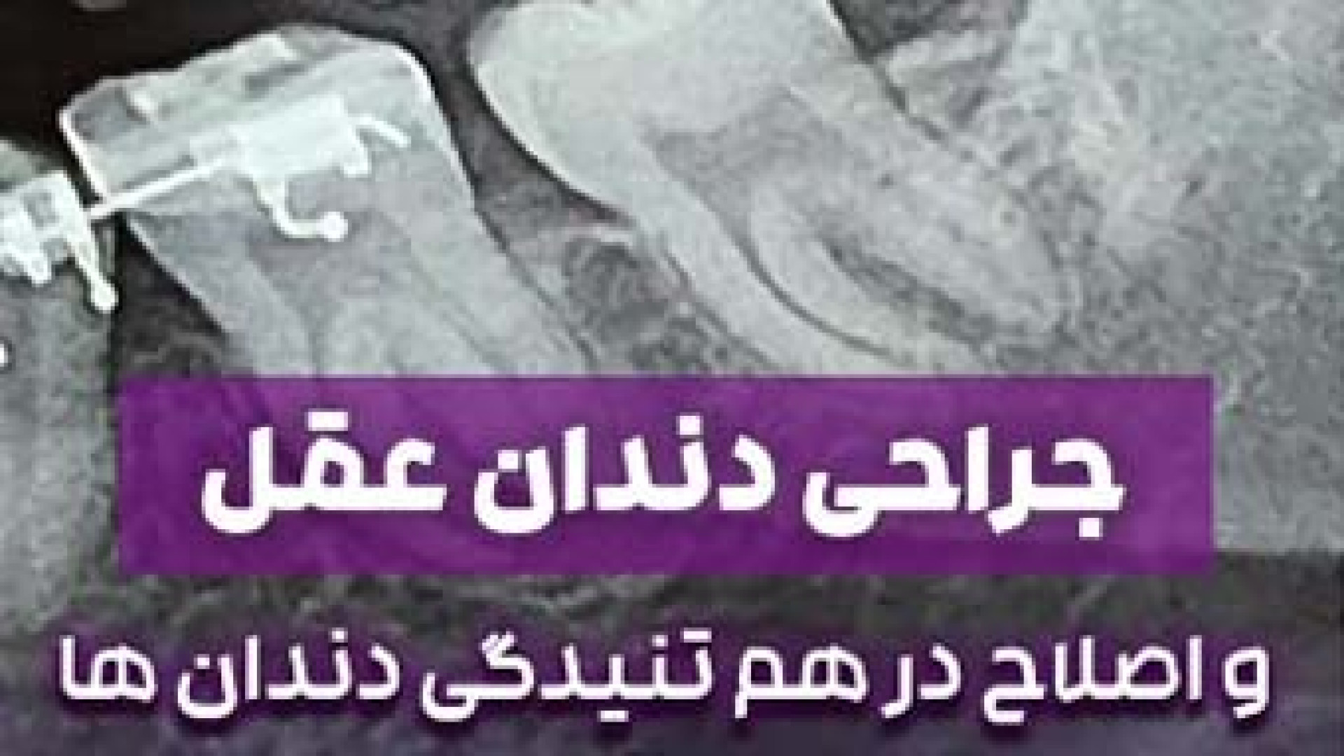جراحی، دندان عقل | دکتر ثریا یوسف نژاد دکتر ثریا یوسف نژاد متخصص ارتودنسی بابل